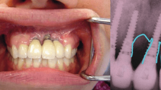 Erfolgreiche Periimplantitisprophylaxe
