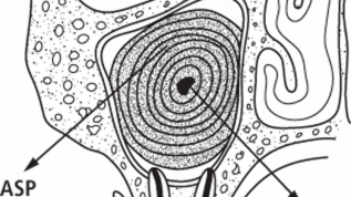 Aspergillose der Kieferhöhle