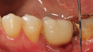 Moderne Periimplantitistherapie