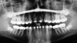 Orale Rehabilitation – kieferortho. Lückenschluss?