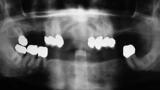 Laterale Augmentation ­horizontaler Knochendefekte