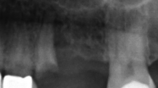 Differenzialanwendung von Implantatplattformen