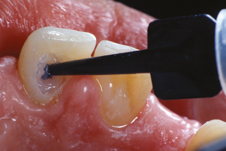 Bleaching Devitaler Zahne Zusatzleistung Endodontie Zwp Online Das Nachrichtenportal Fur Die Dentalbranche