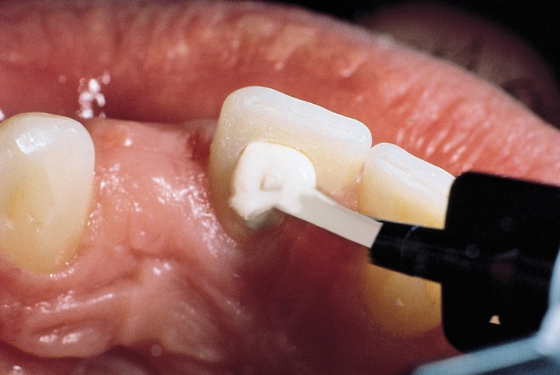 Bleaching Devitaler Zahne Zusatzleistung Endodontie Zwp Online Das Nachrichtenportal Fur Die Dentalbranche