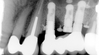 Stadiengerechte Therapie der Periimplantitis