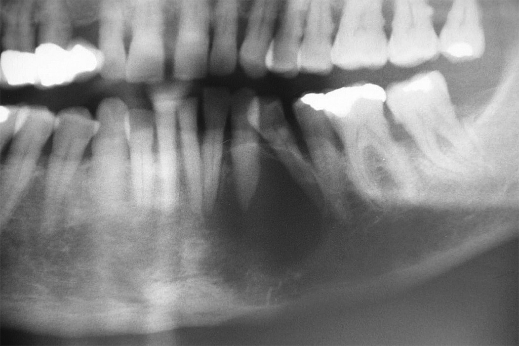 Sonografie einer Zyste mit Knochendefekt ZWP