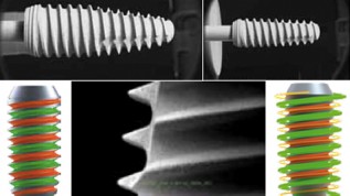 3-D-Augmentation mit simultaner Implantation
