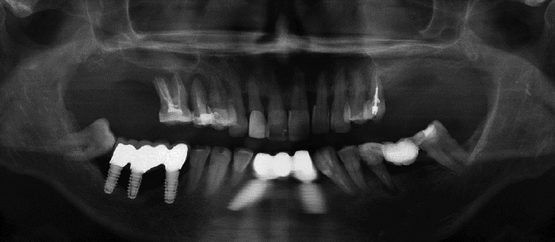 Periimplantitis Analyse Und Hinweise Zur Implantatauswahl Zwp Online Das Nachrichtenportal Fur Die Dentalbranche