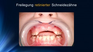 Freilegung retinierter Schneidezähne mittels Laser