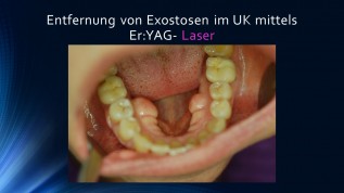 Entfernung von Exostosen im UK mittels Laser