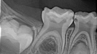 Was ist neu in der Milchzahnendodontie?