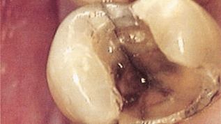 Tief zerstörte Zähne erhalten