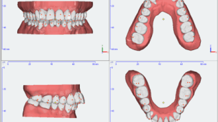Nächste Generation: Direkt 3D-gedruckte Aligner