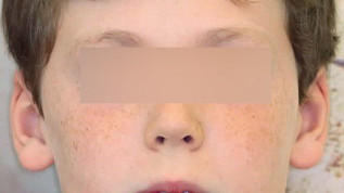 Zehn Jahre Alignertherapie – ein Erfahrungsbericht aus dem Praxisalltag