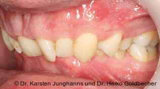 Zahnerhalt durch Kieferorthopädie – Therapie eines ausgeprägten Deckbisses