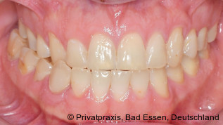 Okklusionsqualität von erwachsenen Patienten mit posteriorem Kreuzbiss