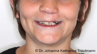 Interdisziplinäre Rehabilitation eines komplexen Patientenfalles mit unilateraler Lippen-Kiefer-Gaumen-Spalte