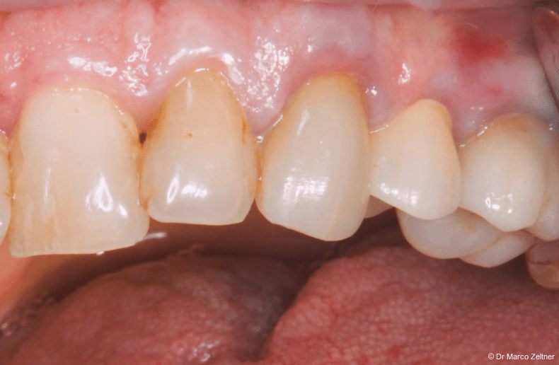 Fig. 1a: An elderly patient presented with loose crowns and apical infections affecting teeth #23 and #24. Both teeth had a hopeless prognosis, and the crowns were removed without resistance.