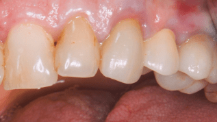 Immediate implant placement with simultaneous GBR in a complex patient
