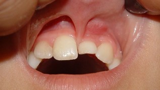 Verlagerung und Retention von Zähnen: Ätiologie, Diagnostik und Behandlungsplanung