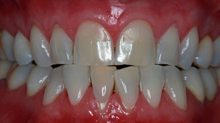 OK-Frontversorgung mit Feldspatkeramik-Veneers trotz Parafunktion
