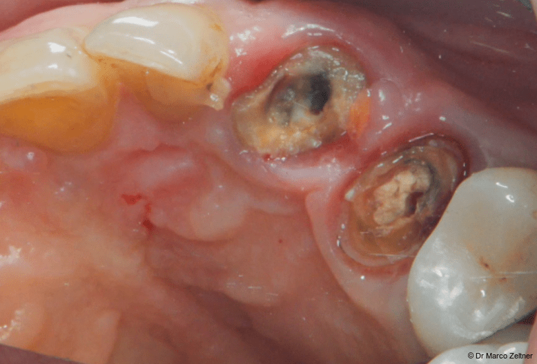 Fig. 1b: An elderly patient presented with loose crowns and apical infections affecting teeth #23 and #24. Both teeth had a hopeless prognosis, and the crowns were removed without resistance.