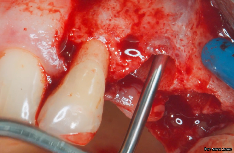 Fig. 2: Clinical examination revealed an extremely thin buccal bone wall.