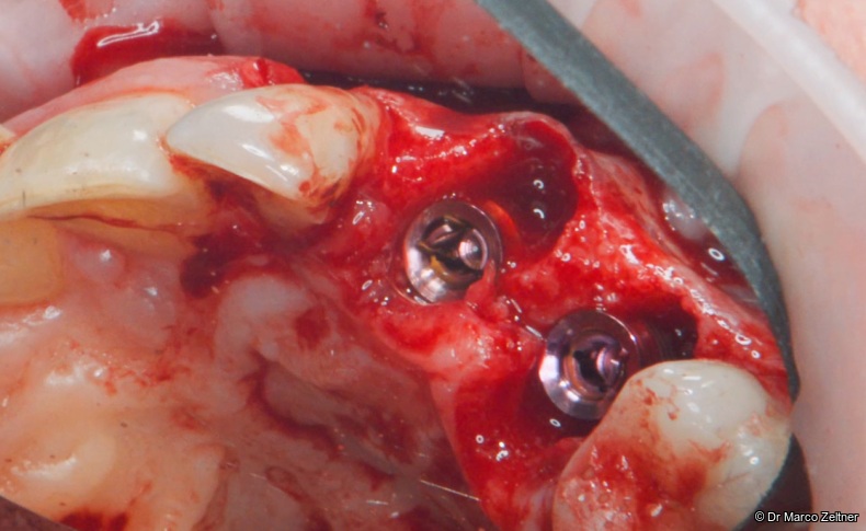 Fig. 3: Tissue-level implants measuring 4.1 × 10 mm (Matrix®, TRI) were
placed immediately at sites #23
and #24 using a guided surgical
approach.