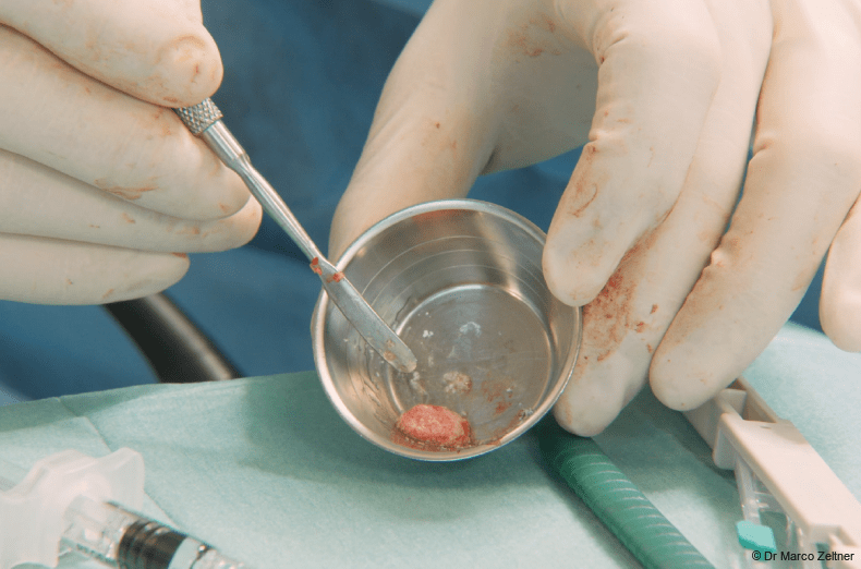 Fig. 4: Autologous bone was combined with 0.5 g of small Geistlich Bio-Oss® granules and REGENFAST® to promote faster healing.