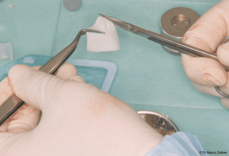 Fig. 5: The Geistlich Bio-Gide® Forte membrane was hydrated with sterile saline and trimmed to conform to the defect morphology.
