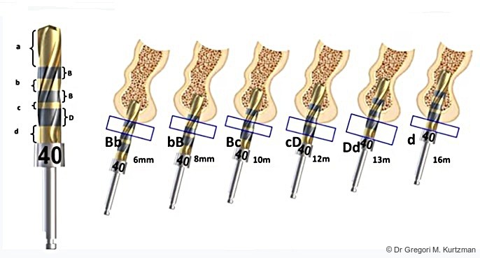Fig. 5: Crown Down osteotomy preparation using a 4.0 mm drill, with sequential advancement progressively enlarging the osteotomy from the crestal cortex to the final depth, reducing drilling torque and heat generation.