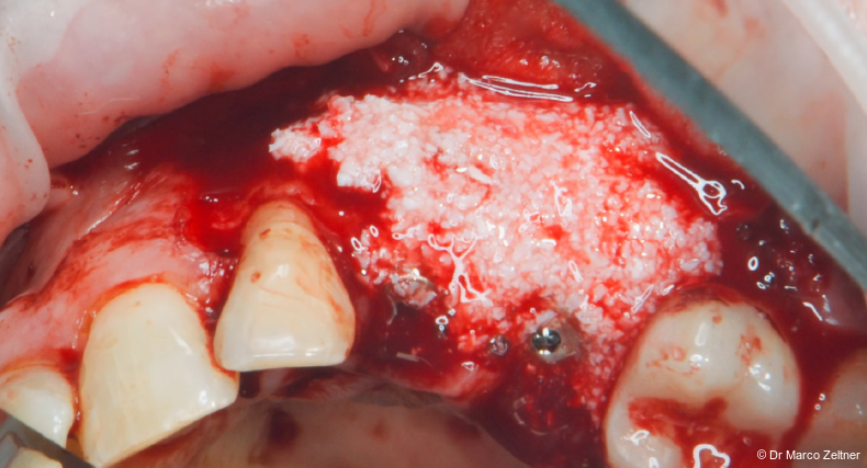 Fig. 6: The defect was grafted with the mixture of autologous bone, Geistlich Bio-Oss®, and REGENFAST®.