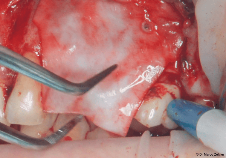 Fig. 7a: The membrane was positioned over the graft and stabilised with resorbable pins.