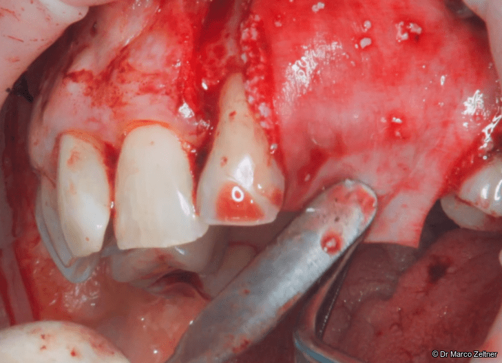 Fig. 7b: The membrane was positioned over the graft and stabilised with resorbable pins.
