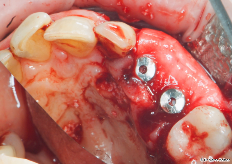 Fig. 8: A small incision was made in the
membrane to adapt it around the
healing abutments. REGENFAST®
was then applied to the Geistlich
Bio-Gide® Forte membrane.