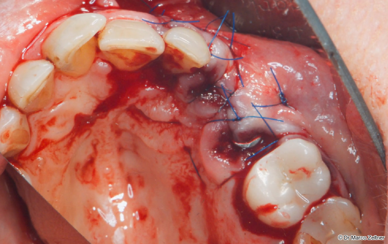 Fig. 9a: The surgical site was closed using two horizontal mattress sutures and additional single interrupted sutures.