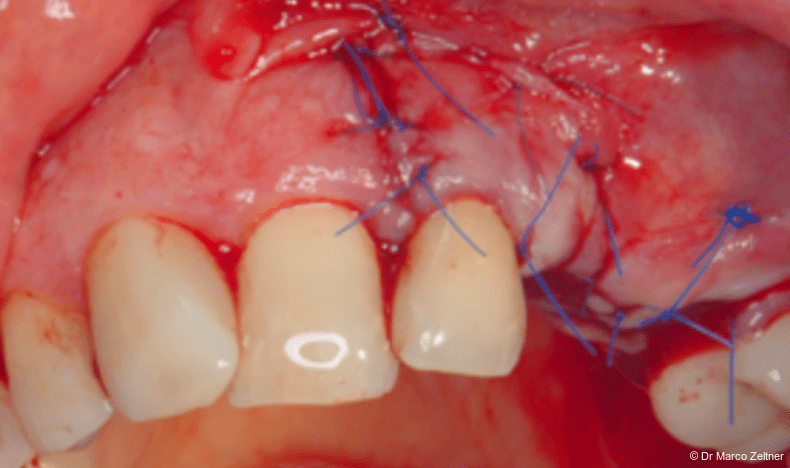 Fig. 9b: The surgical site was closed using two horizontal mattress sutures and additional single interrupted sutures.