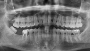 Zweizeitige Implantattherapie bei Einzelzahnversorgung