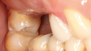Individuelle CAD/CAM-Abutments auf Keramikimplantaten