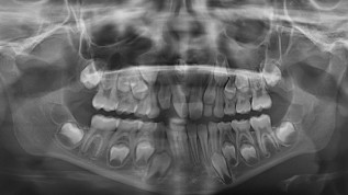 Mesiodens mit enger Lagebeziehung zur Apertura piriformis