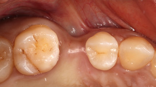 Korrektive Konturaugmentation eines residualen Implantatdehiszenzdefekts