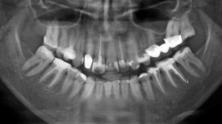 Biologische Zahnmedizin und Keramikimplantate