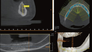 Implantatgetragene Stegversorgung im Unterkiefer