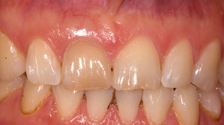 Sofortimplantation mit Keramikimplantaten in der ästhetischen Zone