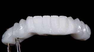 Die Rolle des Zirkonoxidgerüstes beim Micro-Layering