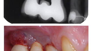 Implantate bei Parodontitispatienten – Dürfen wir das?