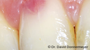 Therapie einer externen ­invasiven zervikalen Resorption