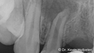 Ausgedehnte apikale Osteolyse mit orthogradem MTA-Verschluss