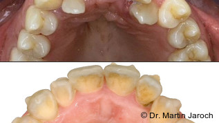Aligner bei Kindern und Jugendlichen – Effizienz, Ästhetik und wissenschaftliche Evidenz im Wachstumsvorteil