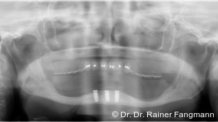 (Sofort-)Versorgung – Anforderung, Umsetzung und Alltag